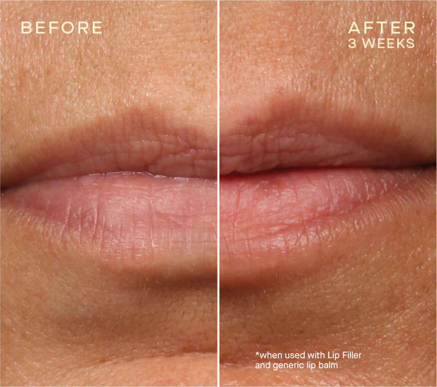 Lip Filler Refill 1.7 mL (x2) 850038687120