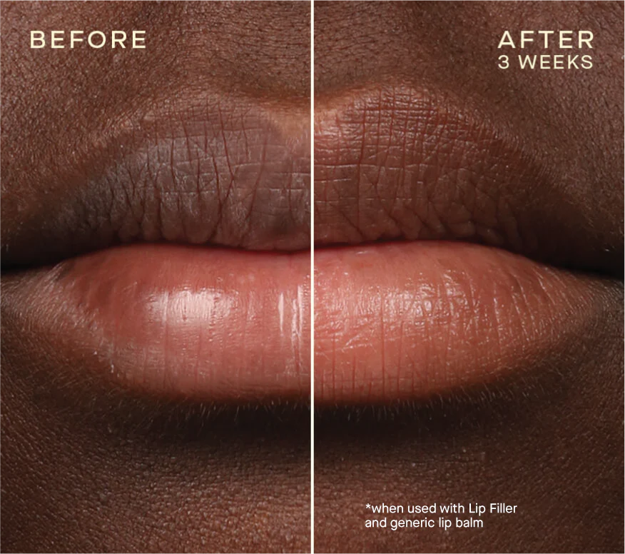 Lip Filler Refill 1.7 mL (x2) 850038687120